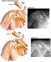 Personal Injury