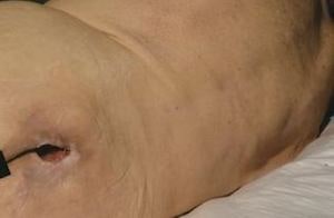 Bedsore Caused by Negligent Nursing Home Personnel