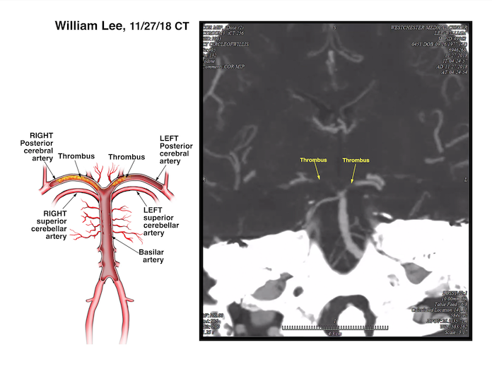 Cerebral Arteries Radiography